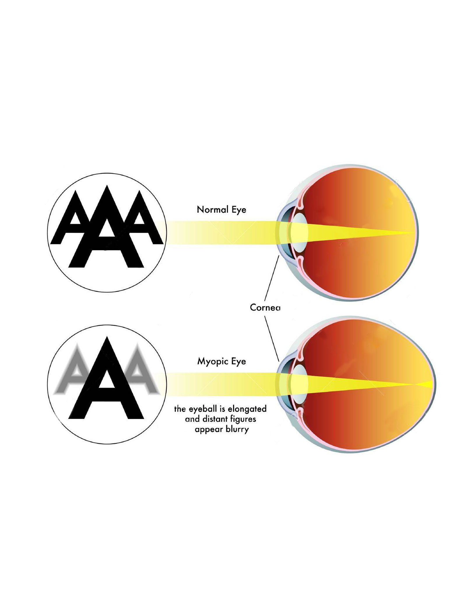 astigamatism