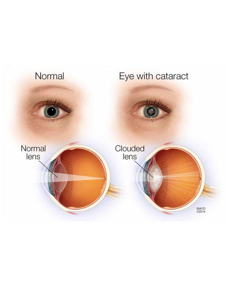 Cataract – EyeOL UK Limited