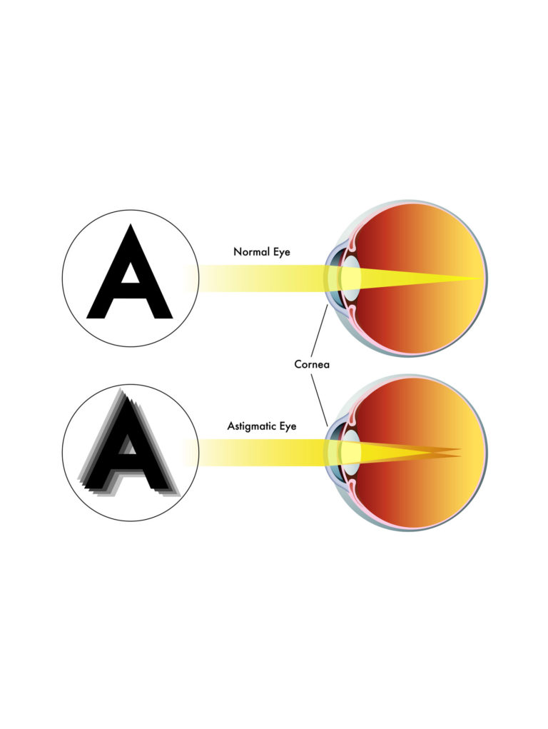 Как видят с астигматизмом